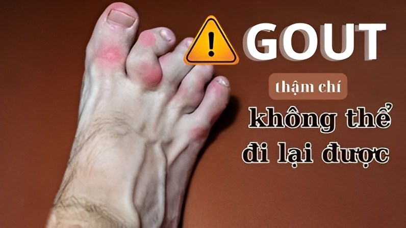  Thực phẩm tốt cho người bệnh Gout