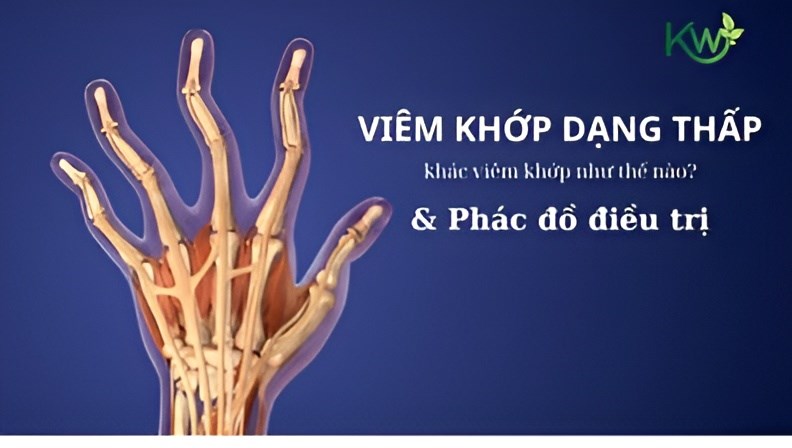  Viêm Khớp dạng thấp